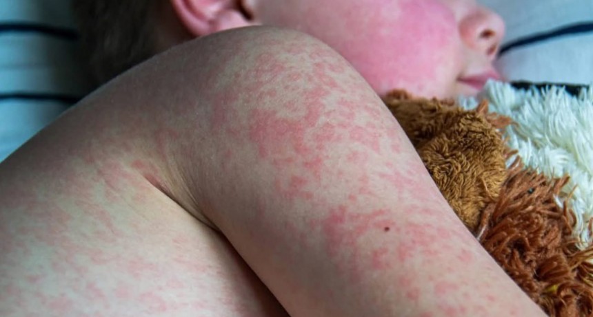 Sarampi&oacute;n: la SAP record&oacute; la importancia de vacunar a los m&aacute;s chicos con la Doble y Triple viral